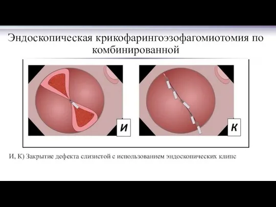 Эндоскопическая крикофарингоэзофагомиотомия по комбинированной И, К) Закрытие дефекта слизистой с использованием эндоскопических клипс