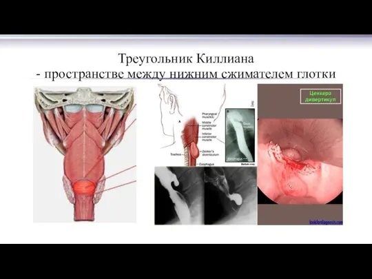 Треугольник Киллиана - пространстве между нижним сжимателем глотки