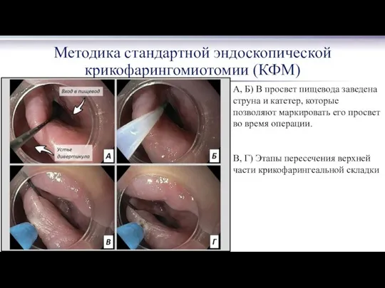 Методика стандартной эндоскопической крикофарингомиотомии (КФМ) А, Б) В просвет пищевода заведена