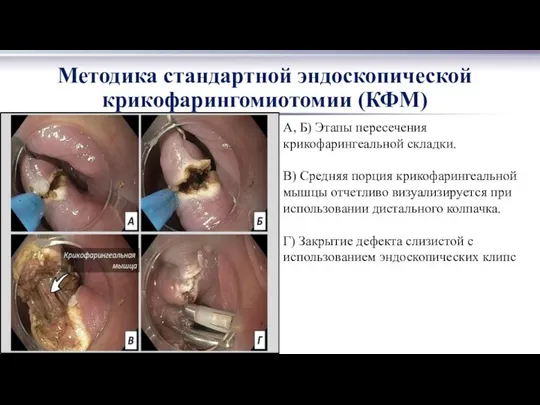 Методика стандартной эндоскопической крикофарингомиотомии (КФМ) А, Б) Этапы пересечения крикофарингеальной складки.