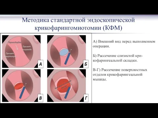 Методика стандартной эндоскопической крикофарингомиотомии (КФМ) А) Внешний вид перед выполнением операции.