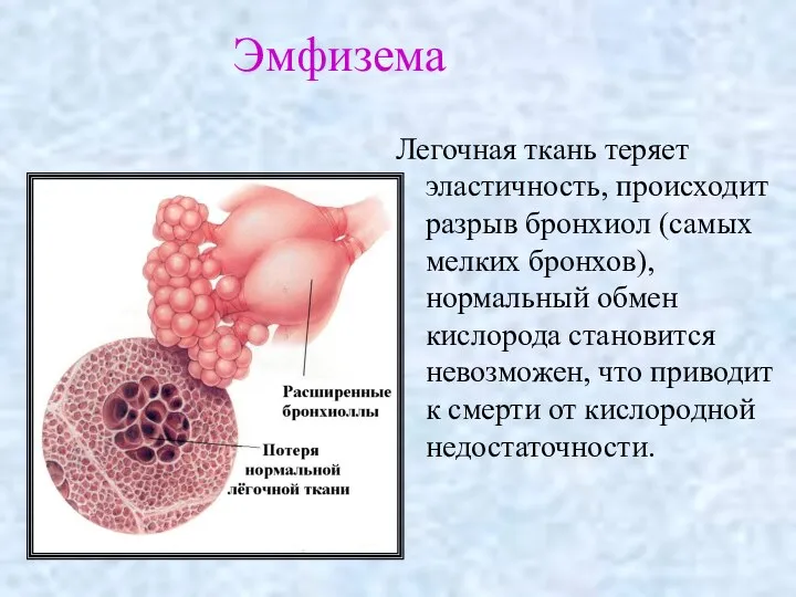 Эмфизема Легочная ткань теряет эластичность, происходит разрыв бронхиол (самых мелких бронхов),