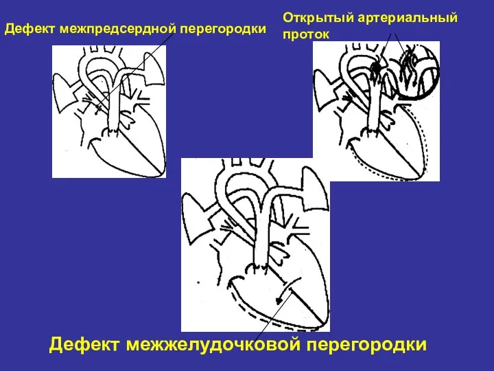 Дефект межпредсердной перегородки Открытый артериальный проток Дефект межжелудочковой перегородки