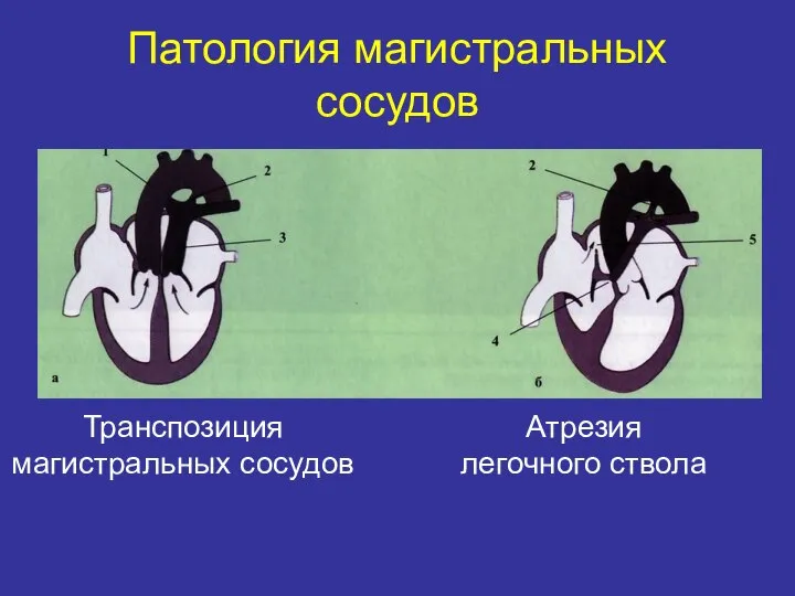 Транспозиция магистральных сосудов Патология магистральных сосудов Атрезия легочного ствола