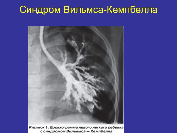 Синдром Вильмса-Кемпбелла