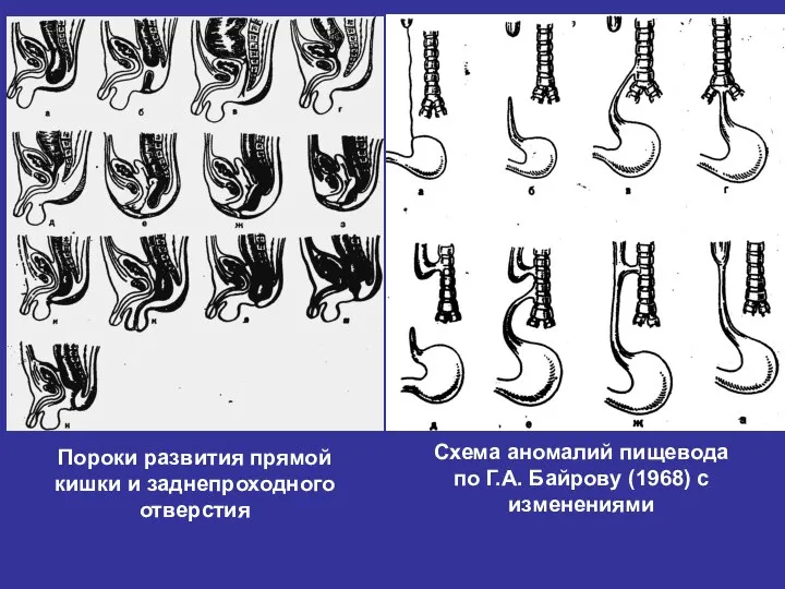 Пороки развития прямой кишки и заднепроходного отверстия Схема аномалий пищевода по Г.А. Байрову (1968) с изменениями