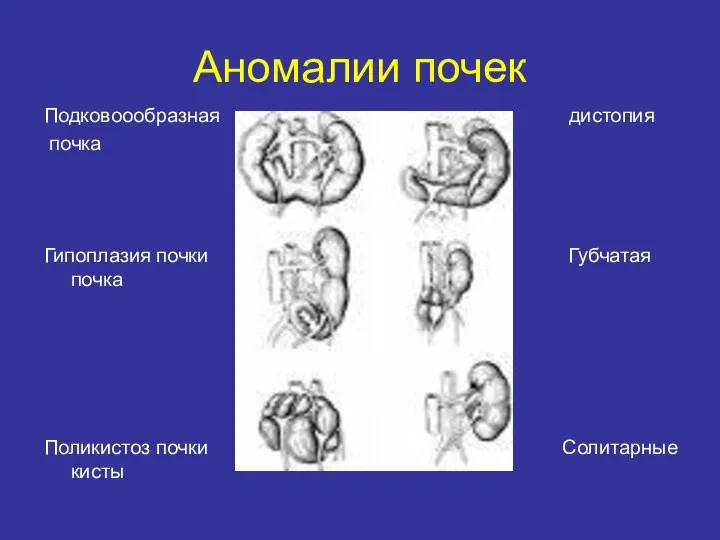 Аномалии почек Подковоообразная дистопия почка Гипоплазия почки Губчатая почка Поликистоз почки Солитарные кисты