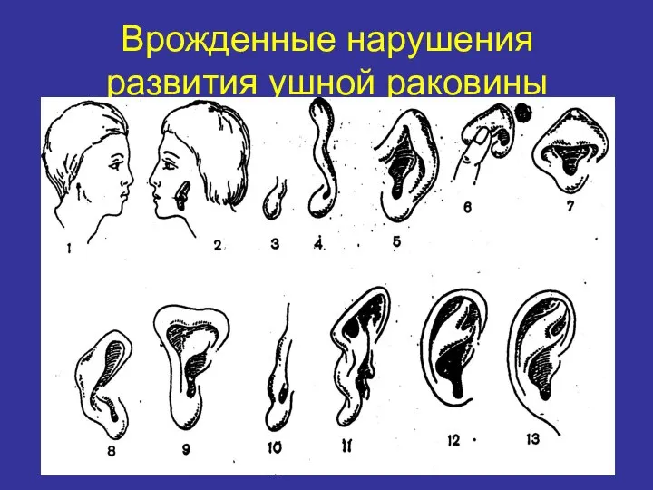 Врожденные нарушения развития ушной раковины