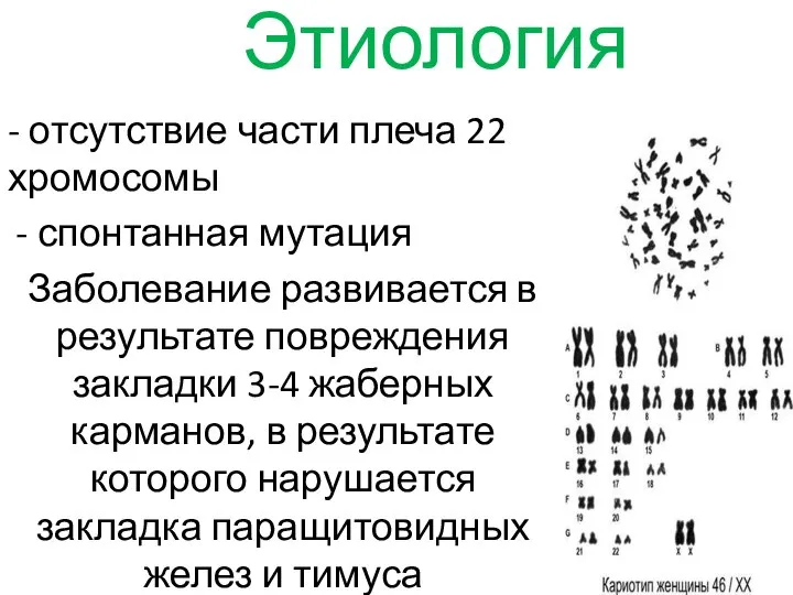 Этиология - отсутствие части плеча 22 хромосомы спонтанная мутация Заболевание развивается