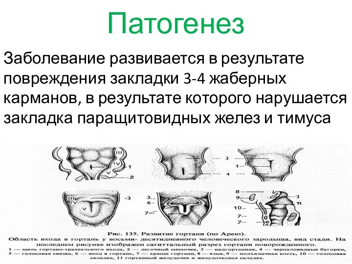 Патогенез Заболевание развивается в результате повреждения закладки 3-4 жаберных карманов, в