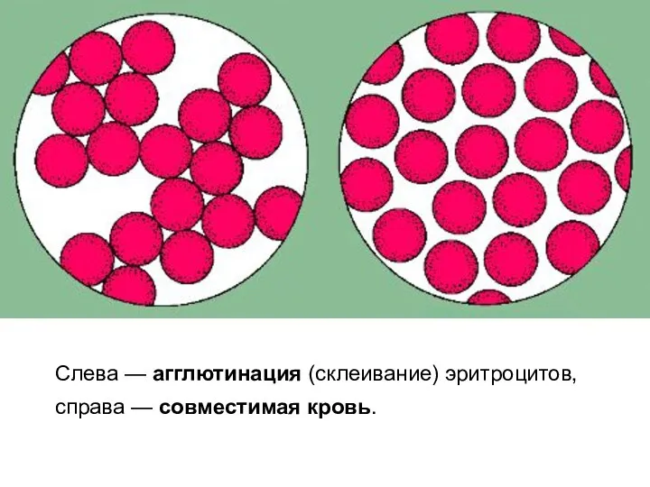 Слева — агглютинация (склеивание) эритроцитов, справа — совместимая кровь.