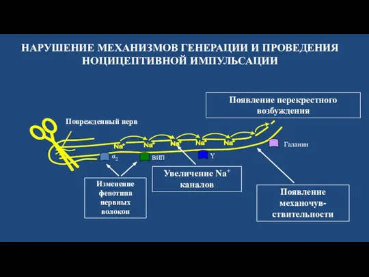 Поврежденный нерв Увеличение Na+ каналов НАРУШЕНИЕ МЕХАНИЗМОВ ГЕНЕРАЦИИ И ПРОВЕДЕНИЯ НОЦИЦЕПТИВНОЙ