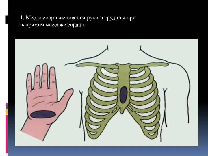 1. Место соприкосновения руки и грудины при непрямом массаже сердца.