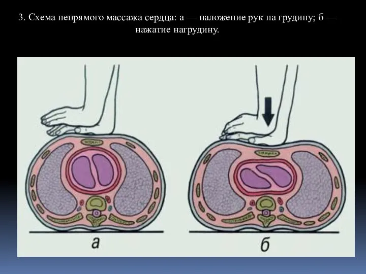 3. Схема непрямого массажа сердца: а — наложение рук на грудину; б — нажатие нагрудину.