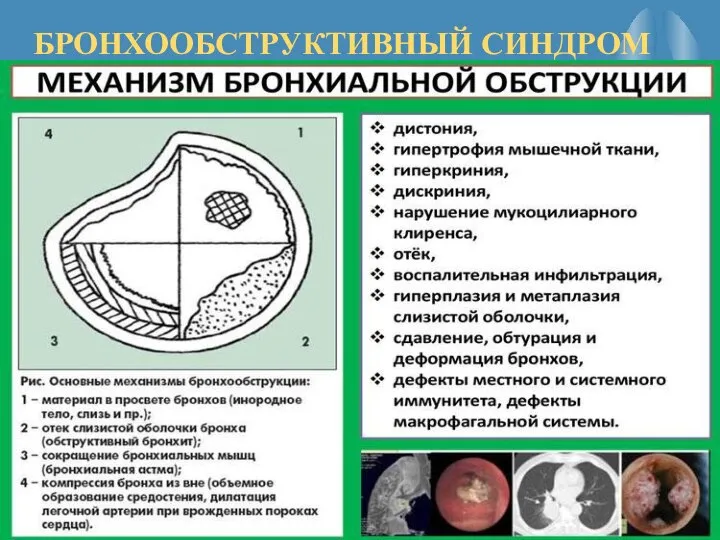 БРОНХООБСТРУКТИВНЫЙ СИНДРОМ