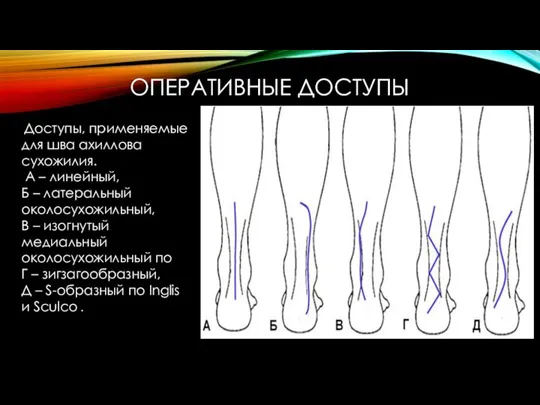 ОПЕРАТИВНЫЕ ДОСТУПЫ Доступы, применяемые для шва ахиллова сухожилия. А – линейный,