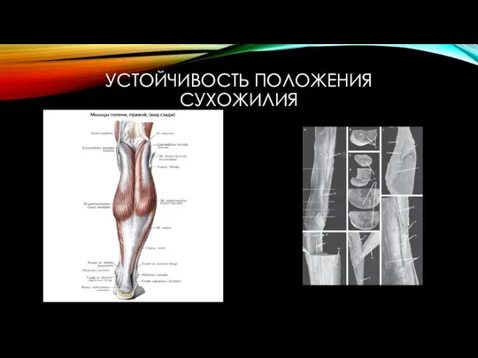 УСТОЙЧИВОСТЬ ПОЛОЖЕНИЯ СУХОЖИЛИЯ