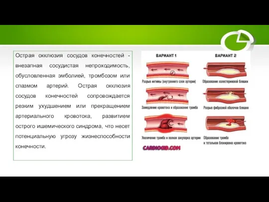 Окклюзия сосудов конечностей Острая окклюзия сосудов конечностей - внезапная сосудистая непроходимость,