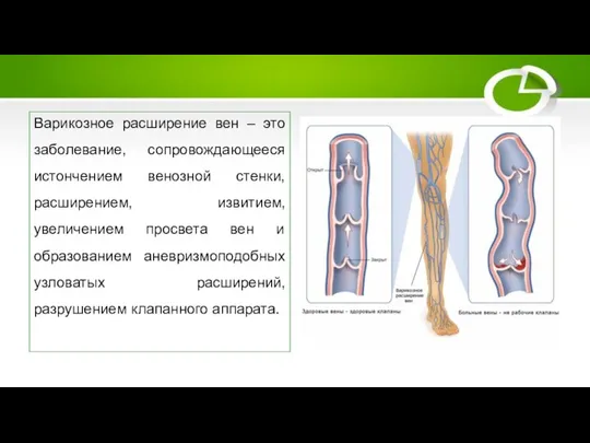 Варикозное расширение вен Варикозное расширение вен – это заболевание, сопровождающееся истончением