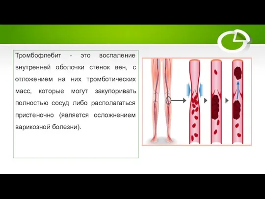Тромбофлебит Тромбофлебит - это воспаление внутренней оболочки стенок вен, с отложением