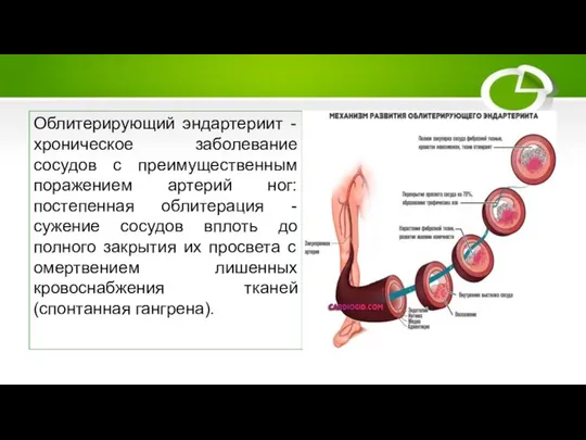 Облитерирующий эндартериит Облитерирующий эндартериит - хроническое заболевание сосудов с преимущественным поражением