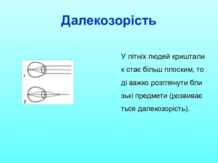 Далекозорість У літніх людей кришталик стає більш плоским, тоді важко розглянути близькі предмети (розвивається далекозорість).