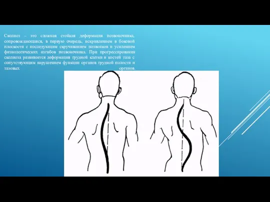 Сколиоз – это сложная стойкая деформация позвоночника, сопровождающаяся, в первую очередь,