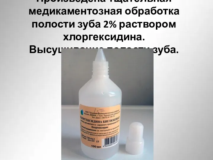 Произведена тщательная медикаментозная обработка полости зуба 2% раствором хлоргексидина. Высушивание полости зуба.