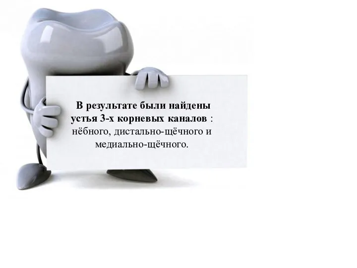 В результате были найдены устья 3-х корневых каналов : нёбного, дистально-щёчного и медиально-щёчного.