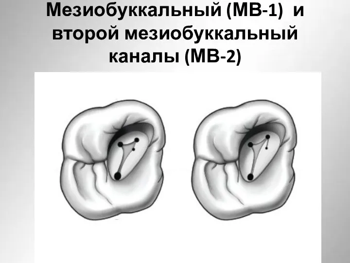Мезиобуккальный (МВ-1) и второй мезиобуккальный каналы (МВ-2)