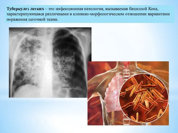 Туберкулез легких – это инфекционная патология, вызываемая бациллой Коха, характеризующаяся различными