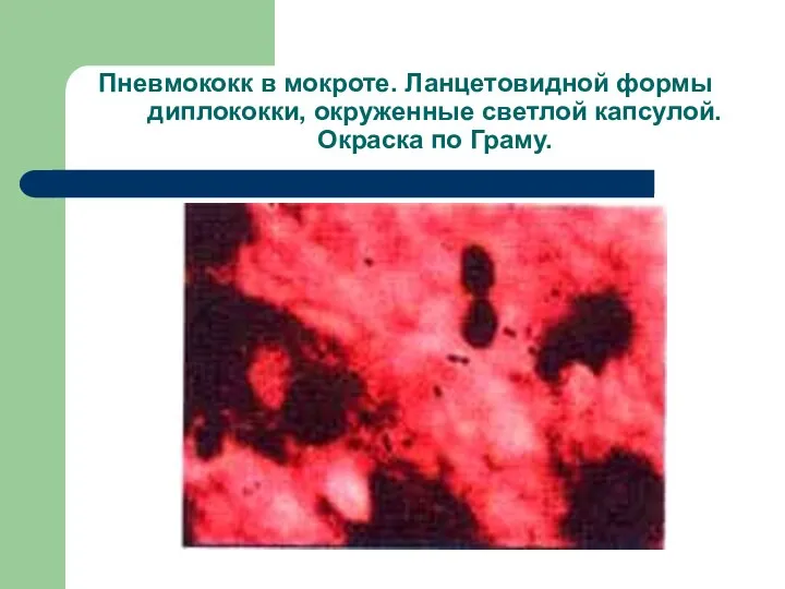 Пневмококк в мокроте. Ланцетовидной формы диплококки, окруженные светлой капсулой. Окраска по Граму.