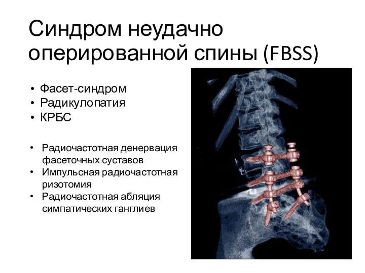 Синдром неудачно оперированной спины (FBSS) Радиочастотная денервация фасеточных суставов Импульсная радиочастотная