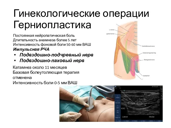 Гинекологические операции Герниопластика Постоянная нейропатическая боль Длительность анамнеза более 5 лет