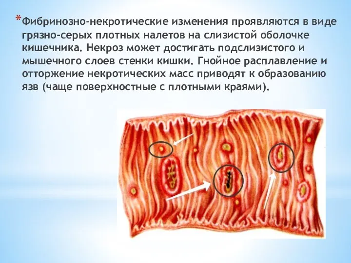 Фибринозно-некротические изменения проявляются в виде грязно-серых плотных налетов на слизистой оболочке