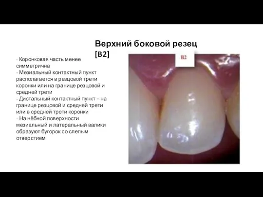 Верхний боковой резец [B2] - Коронковая часть менее симметрична - Мезиальный