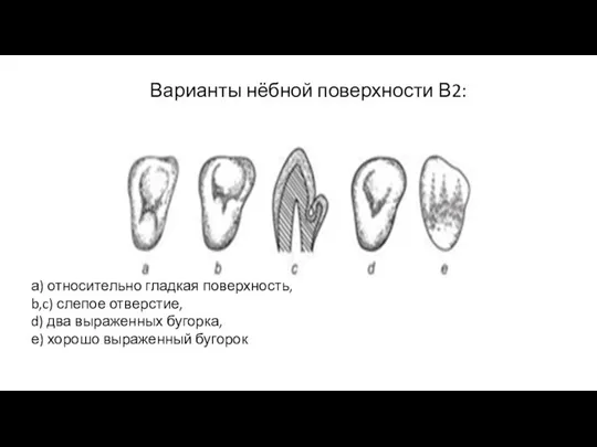 Варианты нёбной поверхности В2: а) относительно гладкая поверхность, b,c) слепое отверстие,