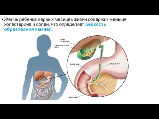 Желчь ребенка первых месяцев жизни содержит меньше холестерина и солей, что определяет редкость образования камней.