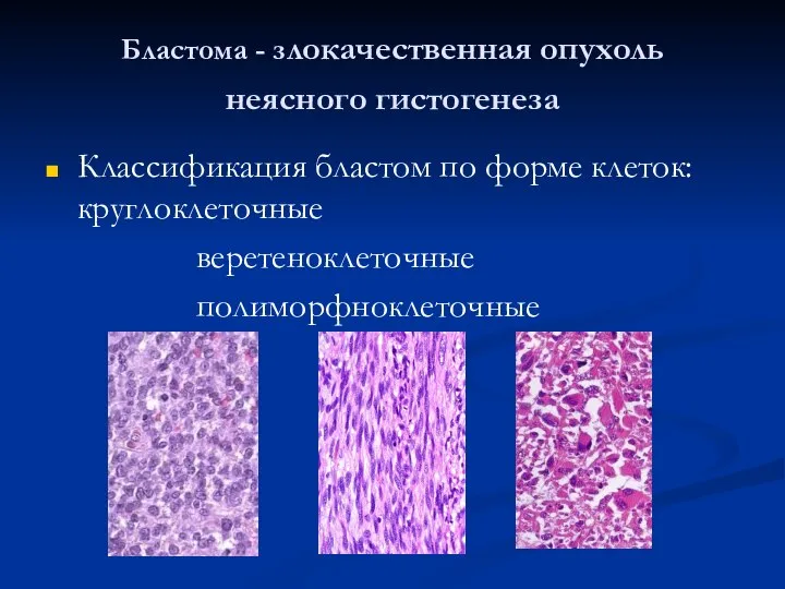 Бластома - злокачественная опухоль неясного гистогенеза Классификация бластом по форме клеток: круглоклеточные веретеноклеточные полиморфноклеточные