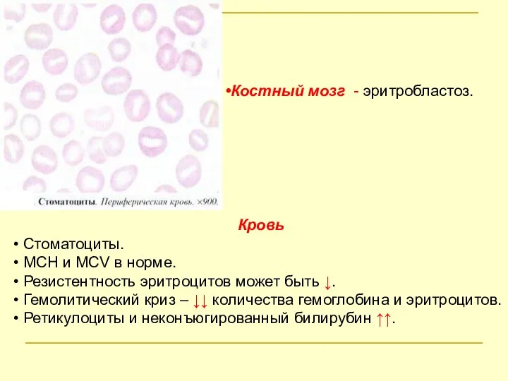 Костный мозг - эритробластоз. Кровь Стоматоциты. MCH и MCV в норме.