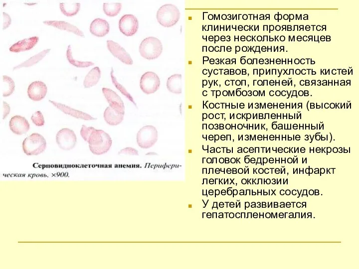 Гомозиготная форма клинически проявляется через несколько месяцев после рождения. Резкая болезненность