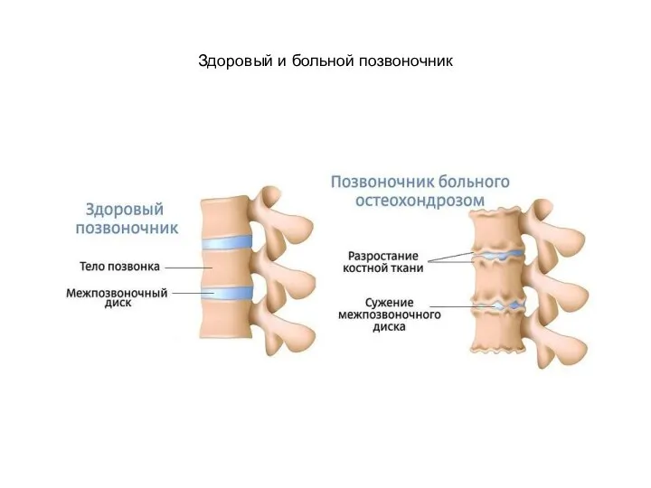 Здоровый и больной позвоночник