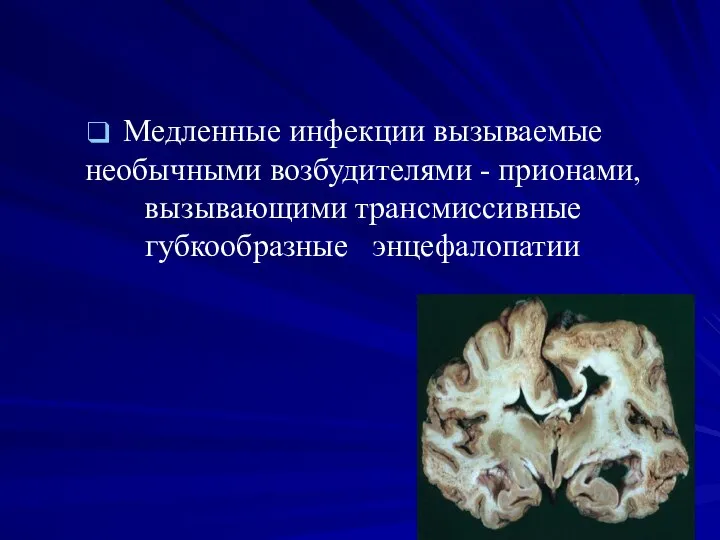 Медленные инфекции вызываемые необычными возбудителями - прионами, вызывающими трансмиссивные губкообразные энцефалопатии