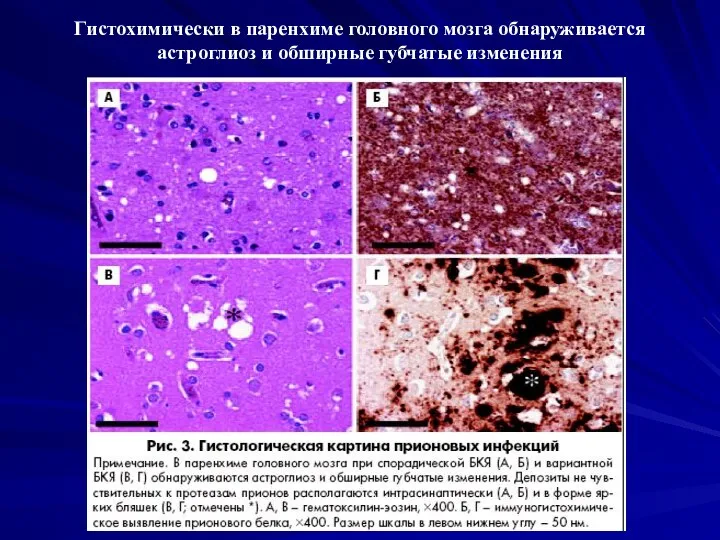 Гистохимически в паренхиме головного мозга обнаруживается астроглиоз и обширные губчатые изменения