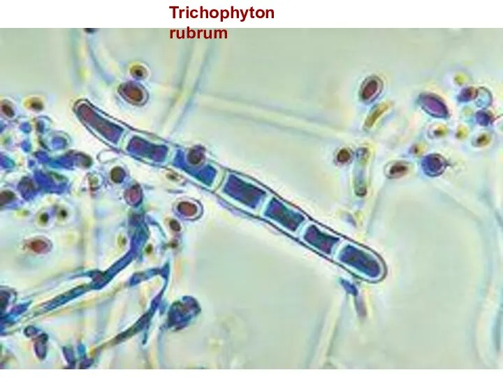 Trichophyton rubrum