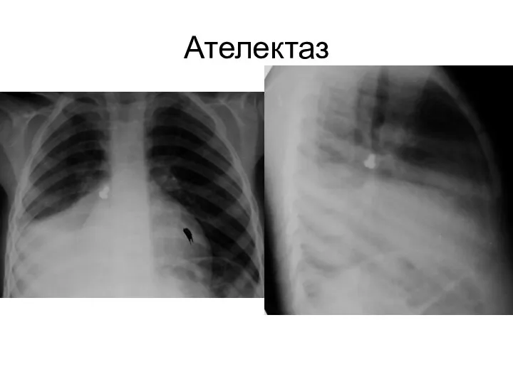 Ателектаз