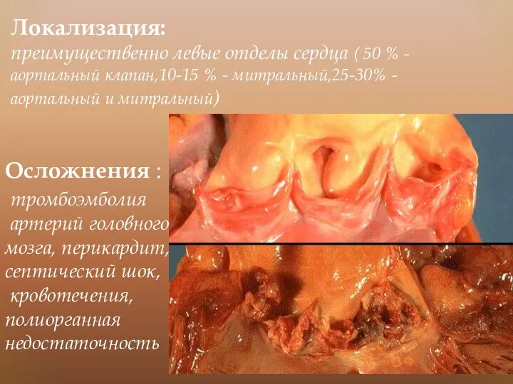 Локализация: преимущественно левые отделы сердца ( 50 % - аортальный клапан,10-15