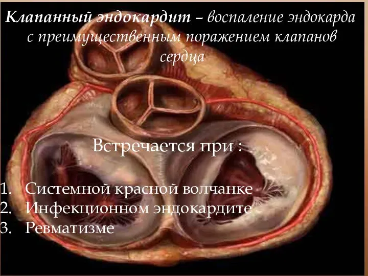 Клапанный эндокардит – воспаление эндокарда с преимущественным поражением клапанов сердца Встречается