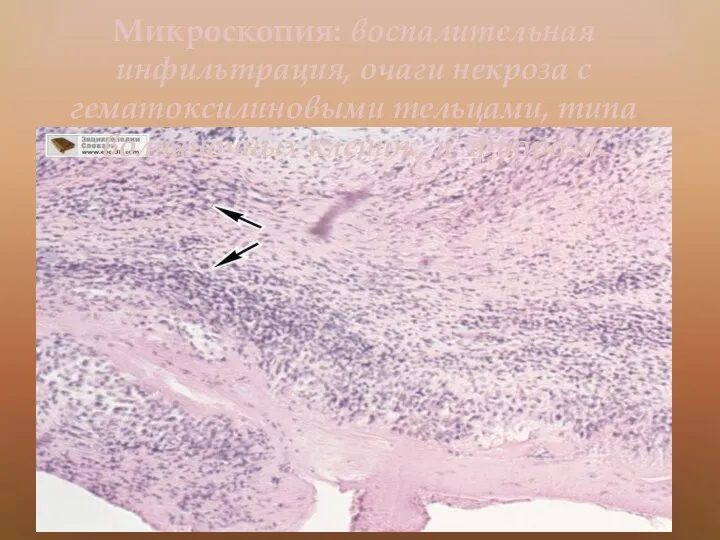 Микроскопия: воспалительная инфильтрация, очаги некроза с гематоксилиновыми тельцами, типа волчаночных клеток, и фиброза.