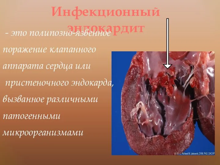 Инфекционный эндокардит - это полипозно-язвенное поражение клапанного аппарата сердца или пристеночного эндокарда, вызванное различными патогенными микроорганизмами